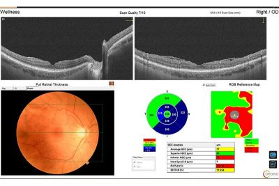 Optovue SOLIX