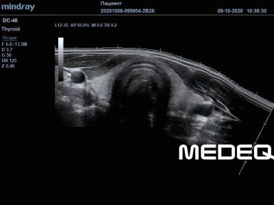 Mindray L12-3E
