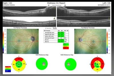 Optovue SOLIX