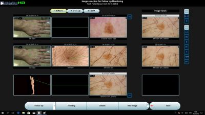 Derma Medical System Molemax HD
